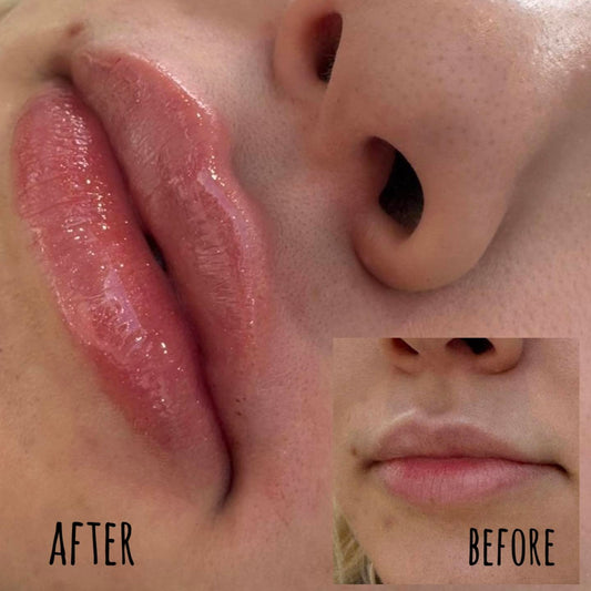 Lip Augmentation: Enhancing Natural Beauty with Subtle Volume