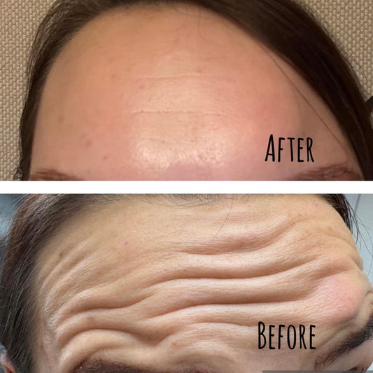 Smooth It Out: Anti-Wrinkle Injections