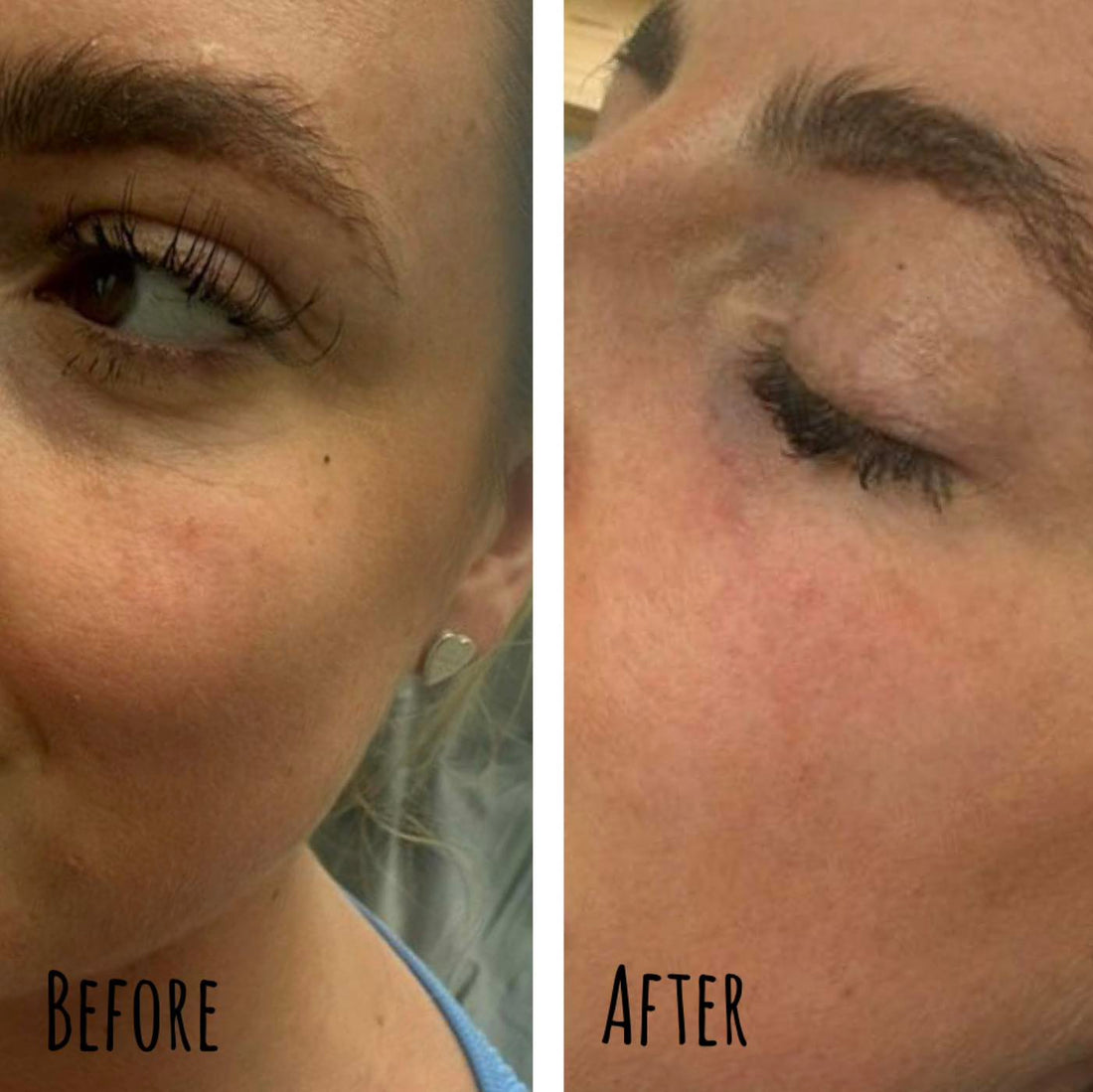 Tear Trough Filler Transformation: Subtle Volume & Brighter Eyes