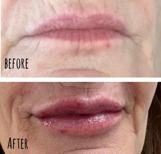 Lip Filler Transformation: Restoring Softness, Shape & Confidence