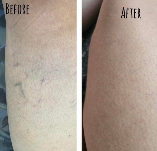 Sclerotherapy Transformation: From Spider Veins to Summer-Ready Skin