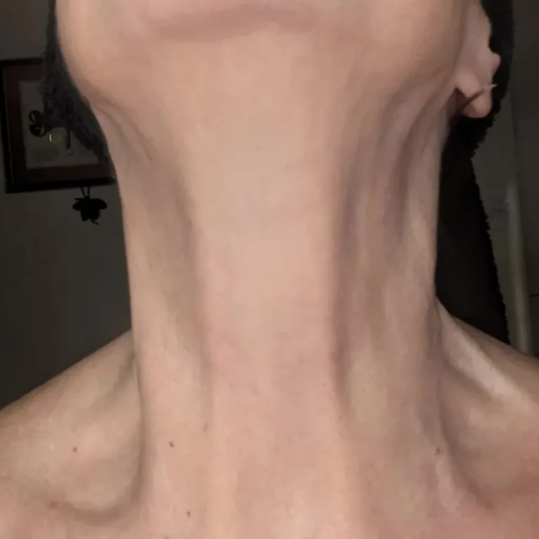 Close-up of the neck showing platysmal bands, platysmal band treatment at Youthify Aesthetics in Bolton