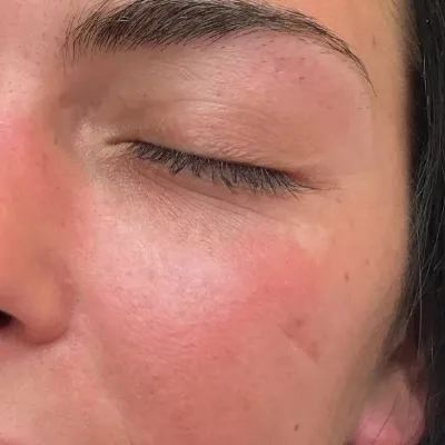 Close-up of the under-eye and cheek, polynucleotides at Youthify Aesthetics in Bolton