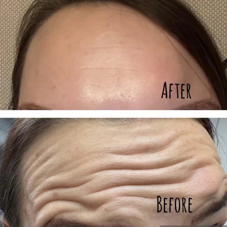 Before and after anti-wrinkle treatment