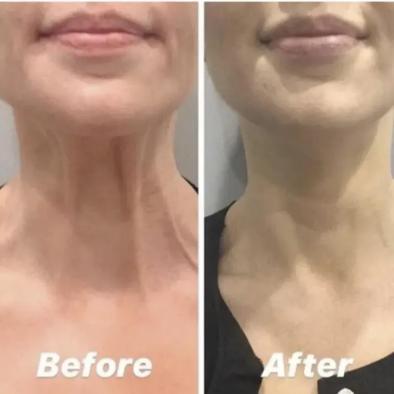 Before and after platysmal bands treatment