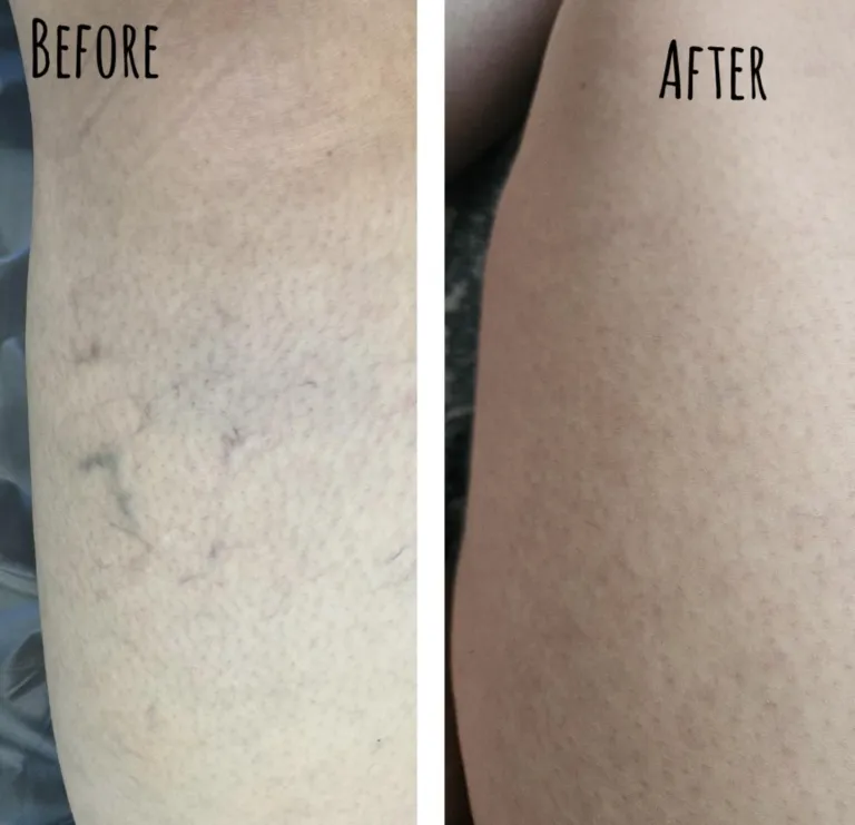 Before and after sclerotherapy treatment