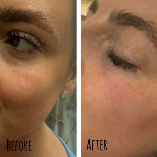 Before and after tear trough treatment
