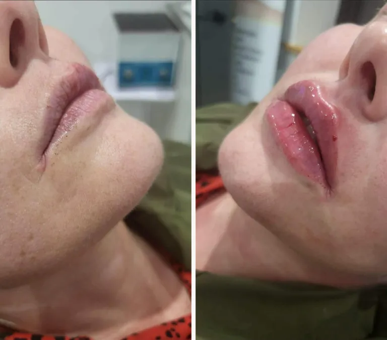 Before and after lip filler treatment